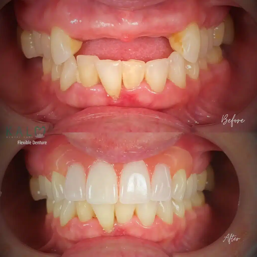 Flexible Denture Bali