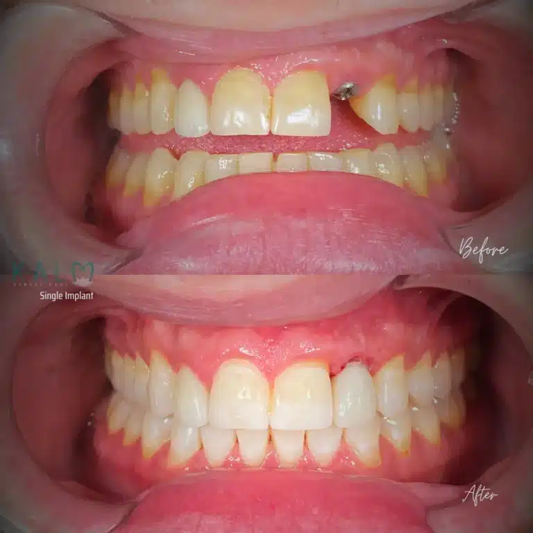 Dental Implant Bali