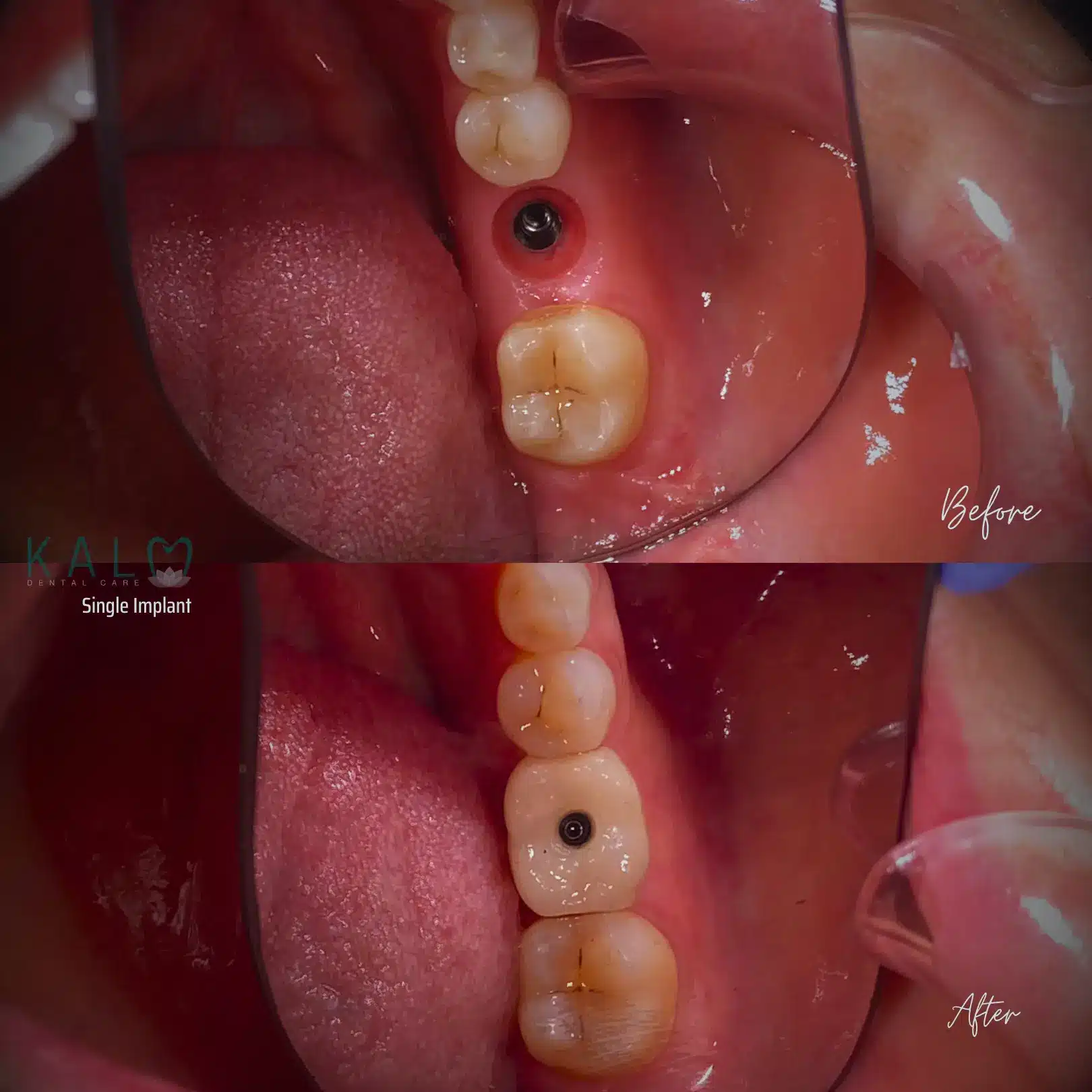 Dental Implant Bali