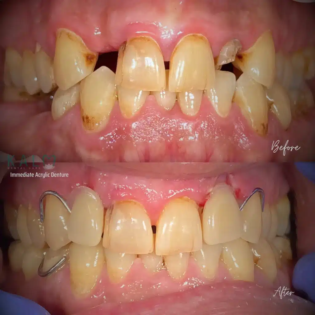 Acrylic Denture in Bali
