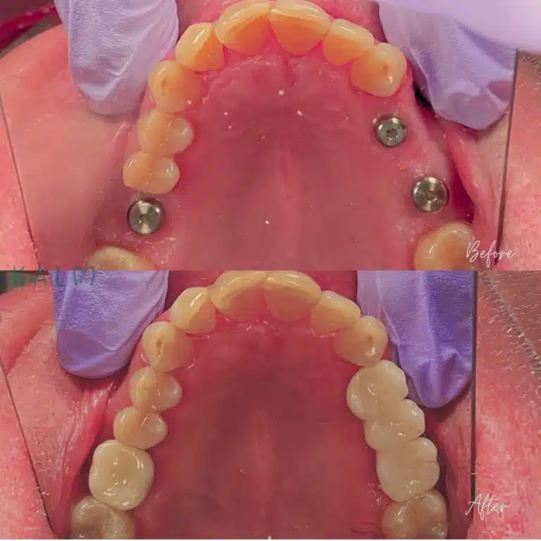 Dental Implant Bali