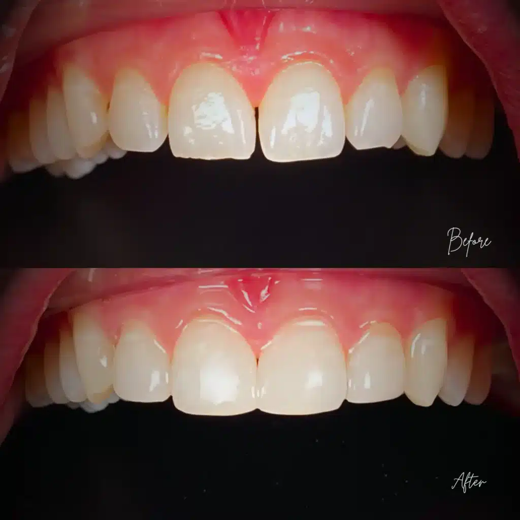 Composite Veneers