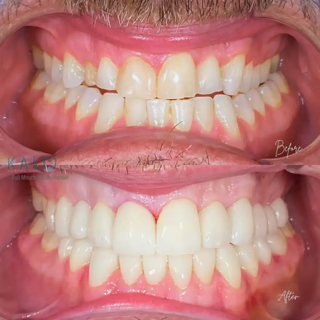 Full Mouth Rehabilitation