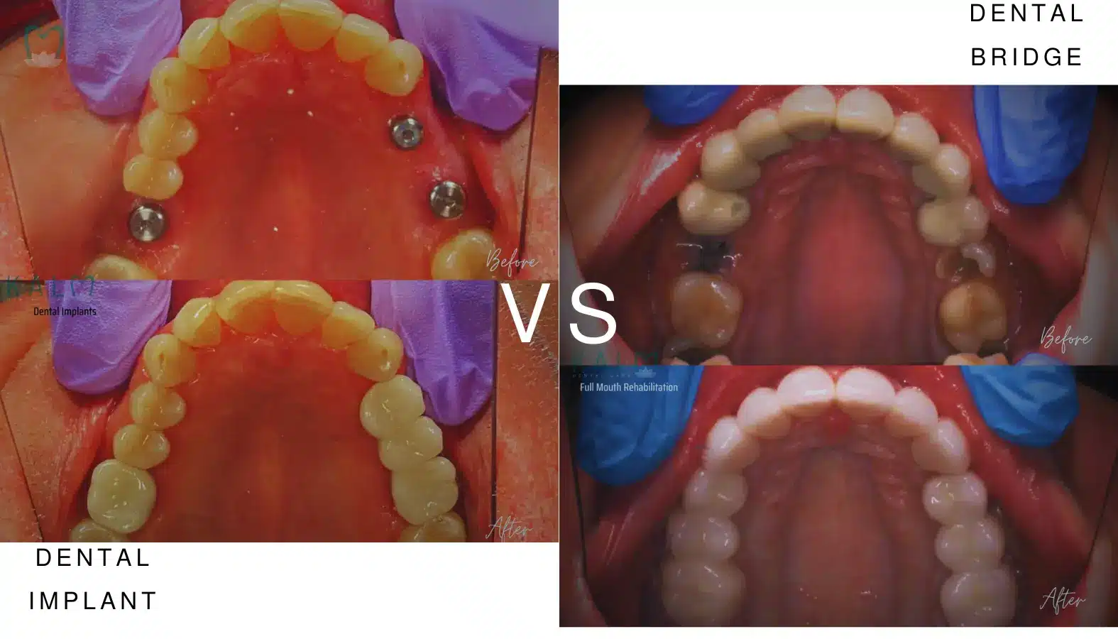 Dental Implant vs Dental Bridge