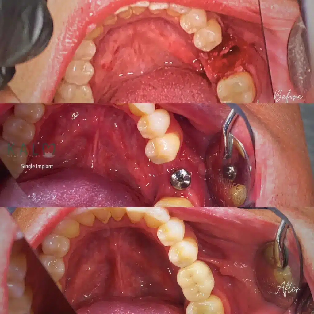 Dental Implant