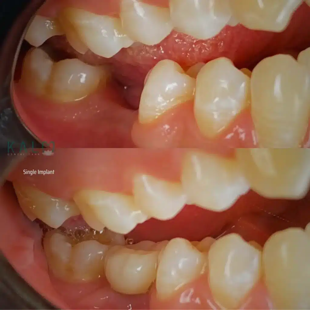 Dental Implant