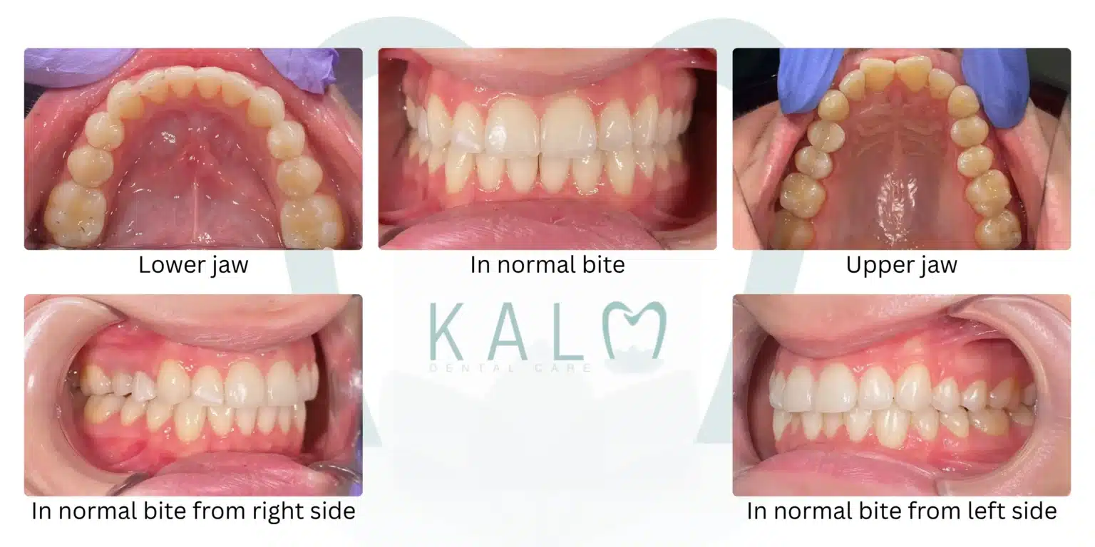 How to Take Clear Teeth Photos for Online Dental Consultation
