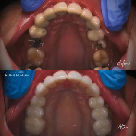 Full Mouth Rehabilitation full mouth rehabilitation bali
